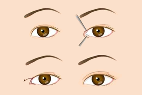 割双眼皮常用方法