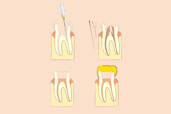 种植牙的寿命与其受磨损以及密闭性好坏有关。