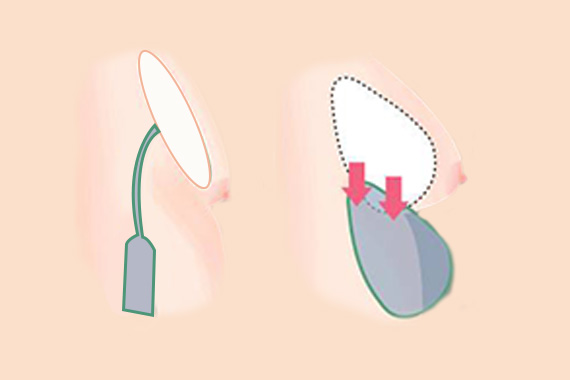 隆胸的快方法主要有三种！先要明确自己是什么类型的乳房！