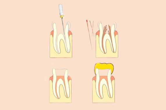 箍牙改变脸型是真的吗 实现变脸不科学