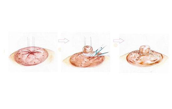 乳头整形术前术后要注意哪些方面？|乳头矫正手术术前准备及检查