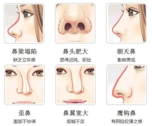 做鼻修复，为什么要一年之后才能做？|隆鼻后鼻头红能修复吗