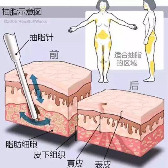 腰腹部吸脂是环吸还是分开吸？