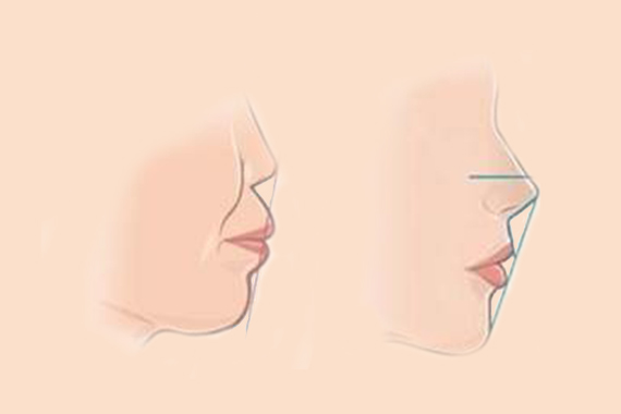 唇裂修复手术后如何护理呢