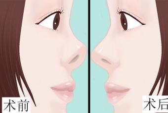 花容网：硅胶隆鼻，让你颜值迅速提升！