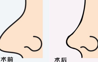 花容网：歪鼻矫正，让你的俏鼻“无可鼻拟”