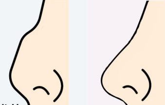 花容网：歪鼻矫正，让你的俏鼻“无可鼻拟”