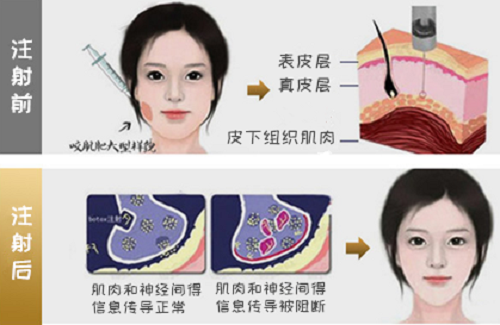 瘦脸*注射1年后,还是不是瓜子脸?