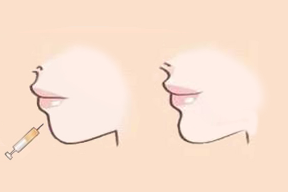自体脂肪在隆鼻的过程中可能会出现哪些意外呢?