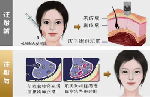 上海医疗美容诊所 注射瘦脸效果好吗