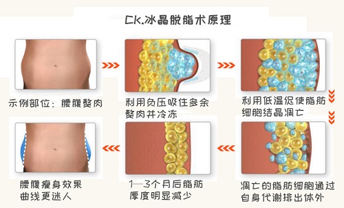 吸脂术后恢复需要多久?