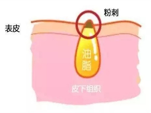 天津建民医疗美容诊所下巴长粉刺是什么原因