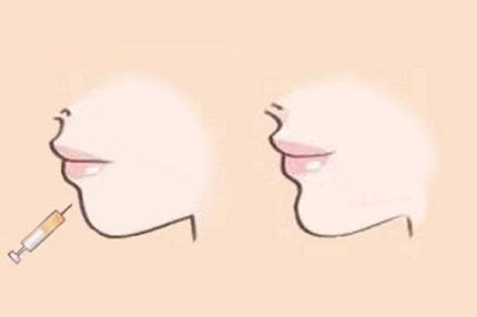 抚顺协和整形美容下巴打玻尿酸能管多久？