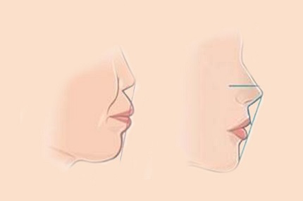 鞍山菲之都整形外科门诊部|注射填充鼻唇沟优势有哪些？