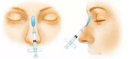 南京维多利亚医疗美容医院综合隆鼻专家分享隆鼻的一些好处。