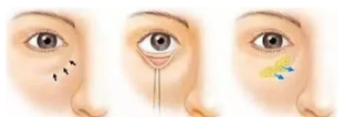 松弛型眼袋的主要发生原因有哪些？重庆时光给你解答。