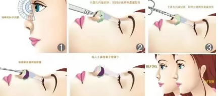 韩式隆鼻的开鼻门方法有两种,韩式微创隆鼻技术主要有哪些?价格