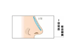 硅胶隆鼻是**的吗?注射缩小鼻尖和鼻小柱,术后效果怎么样？广