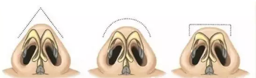 韩式隆鼻的开鼻门方法有两种,韩式微创隆鼻技术主要有哪些?价格