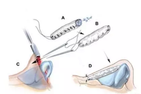 注射隆鼻副作用有哪些？手术的原理是怎么样的？注射后注意事项有