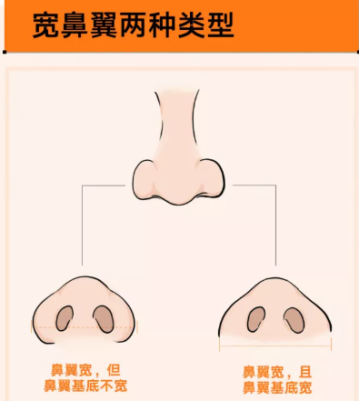 注射隆鼻后注意什么?注射隆鼻材料效果怎么样?北京韩韵坊隆鼻价