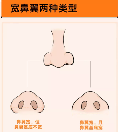 假体隆鼻术后护理要点有哪些？**性高的材料:硅胶与膨体材料。