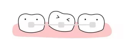 南京雅度口腔做牙齿龅牙效果怎么样?雅度的牙齿案例介绍