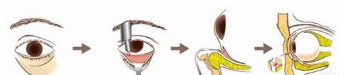 怎么判断自己是眼袋是哪种类型呢?四川米兰柏羽祛眼袋案例分享。