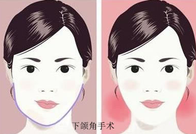 北京圣嘉新医疗美容医院做磨骨手术的案例分享