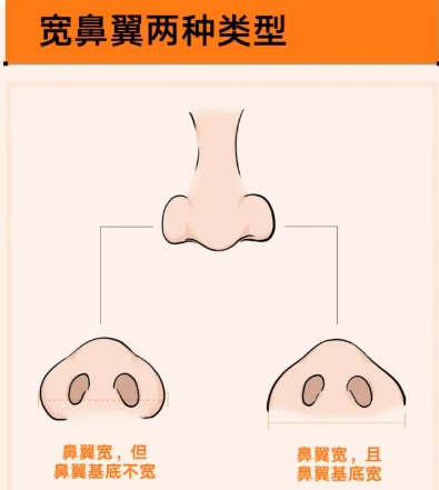 济南艺星隆鼻好不好？看看杨季涛专家隆鼻案例就知道了。