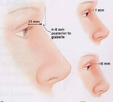 南昌时光隆鼻效果好不好？软骨隆鼻可以维持多久？案例告诉你。