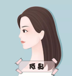 九江协和医疗美容门诊部做假体隆鼻大概可以维持多久？