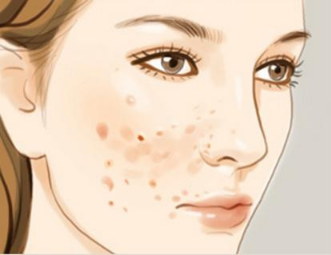 祛痘做完皮肤会变敏感吗？痘痘淡化了许多！祛痘要积极做好护理！