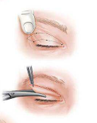 天生双眼皮扇形一个平行怎么办？双眼皮修复的效果看真实案例吧！
