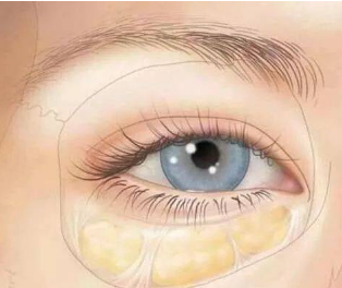 祛眼袋的术后怎么样去护理？激光微创无痕祛眼袋后眼睛是精神多了