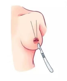 乳头缩小会有影响吗?乳头缩小半侧切除术原理有哪些?值得你关注