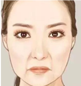 注射提升后的注意事项包括哪些？面部提肌真实案例让越活越年轻!