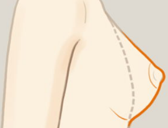 做完副乳切除后还会再长出来吗?为什么有副乳?附隆胸价格表!