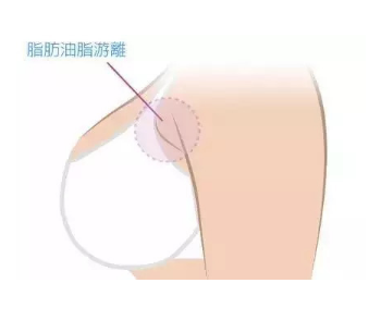 做完副乳切除后还会再长出来吗?为什么有副乳?附隆胸价格表!