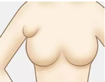 做完副乳切除后还会再长出来吗?为什么有副乳?附隆胸价格表!