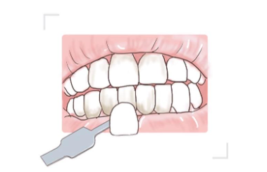 牙齿美白有何优势？牙齿美白的方法介绍！