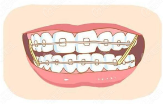 做美白牙齿需要检查哪些？牙齿美白会有危害吗？
