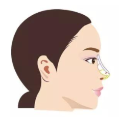 你知道隆鼻有什么好处吗？术后该怎么护理才能更快恢复？