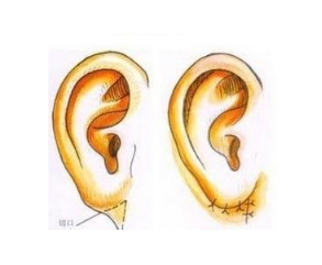 耳垂重建的副作用全方面考虑！耳畸矫正案例+耳朵价格表！