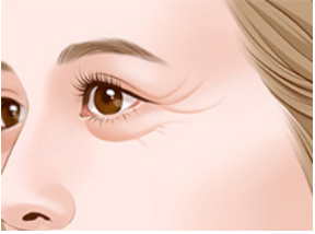 单纯注射玻尿酸能彻底除皱吗？眼部注射除皱方法有哪些？