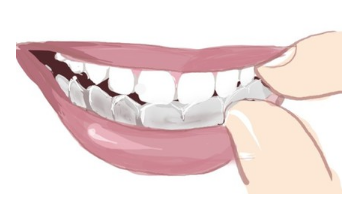 牙科瓷贴面护理方法？术前准备你不知道的小知识！案例！