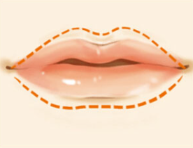 玻尿酸丰唇有几种唇型？如何让效果更好？
