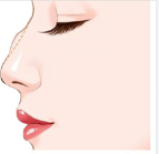 肋骨鼻挛缩是什么情况？鼻整形术后注意事项！手术更有保障！