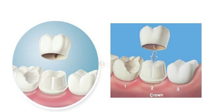 无铍烤瓷牙和钴铬烤瓷牙的区别？全瓷牙术后护理注意每个步骤！