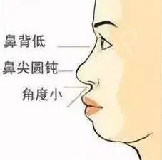 鼻翼缩小能保持多久？鼻翼缩小有什么风险，该如何预防呢？